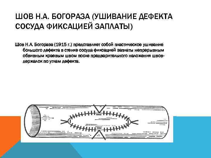 ШОВ Н. А. БОГОРАЗА (УШИВАНИЕ ДЕФЕКТА СОСУДА ФИКСАЦИЕЙ ЗАПЛАТЫ) Шов Н. А. Богораза (1915