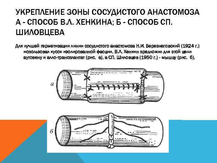 УКРЕПЛЕНИЕ ЗОНЫ СОСУДИСТОГО АНАСТОМОЗА А - СПОСОБ В. Л. ХЕНКИНА; Б - СПОСОБ СП.