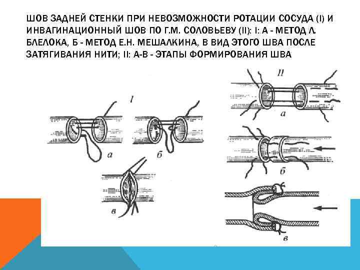 ШОВ ЗАДНЕЙ СТЕНКИ ПРИ НЕВОЗМОЖНОСТИ РОТАЦИИ СОСУДА (I) И ИНВАГИНАЦИОННЫЙ ШОВ ПО Г. М.