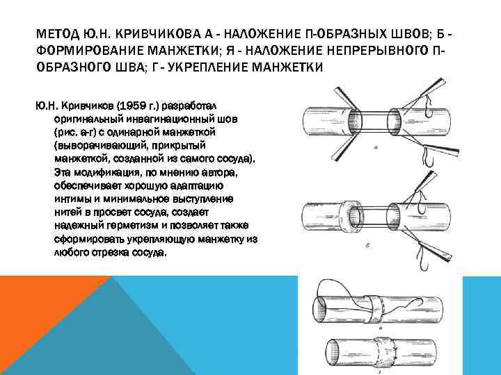 МЕТОД Ю. Н. КРИВЧИКОВА А - НАЛОЖЕНИЕ П-ОБРАЗНЫХ ШВОВ; Б ФОРМИРОВАНИЕ МАНЖЕТКИ; Я -