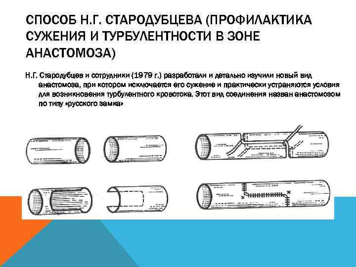 СПОСОБ Н. Г. СТАРОДУБЦЕВА (ПРОФИЛАКТИКА СУЖЕНИЯ И ТУРБУЛЕНТНОСТИ В ЗОНЕ АНАСТОМОЗА) Н. Г. Стародубцев