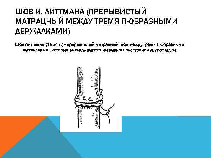 ШОВ И. ЛИТТМАНА (ПРЕРЫВИСТЫЙ МАТРАЦНЫЙ МЕЖДУ ТРЕМЯ П-ОБРАЗНЫМИ ДЕРЖАЛКАМИ) Шов Литтмана (1954 г. )