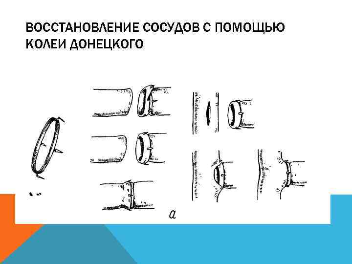 ВОССТАНОВЛЕНИЕ СОСУДОВ С ПОМОЩЬЮ КОЛЕИ ДОНЕЦКОГО 