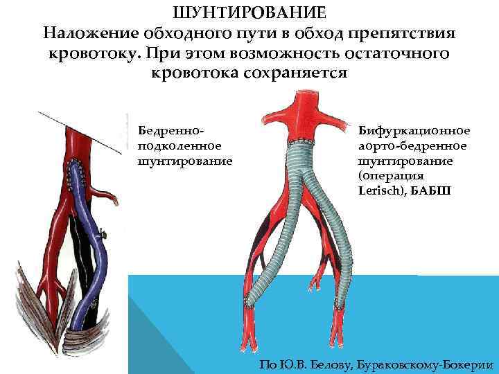 ШУНТИРОВАНИЕ Наложение обходного пути в обход препятствия кровотоку. При этом возможность остаточного кровотока сохраняется