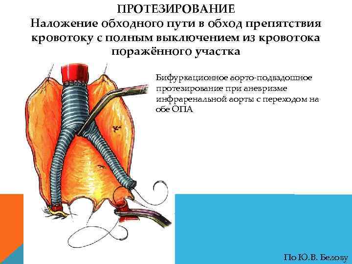 ПРОТЕЗИРОВАНИЕ Наложение обходного пути в обход препятствия кровотоку с полным выключением из кровотока поражённого