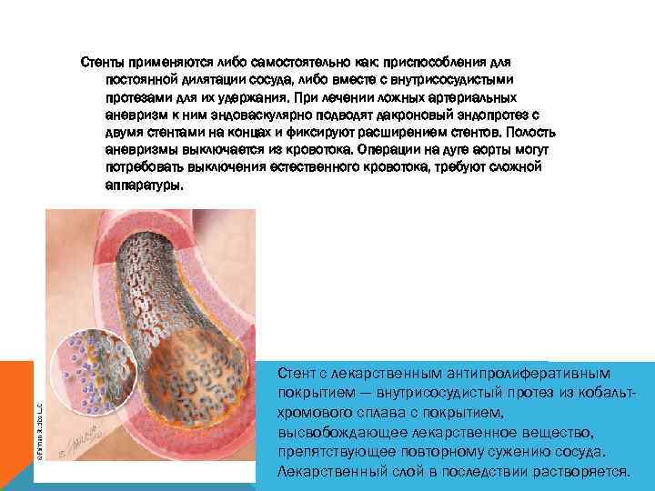 Стенты применяются либо самостоятельно как: приспособления для постоянной дилятации сосуда, либо вместе с внутрисосудистыми