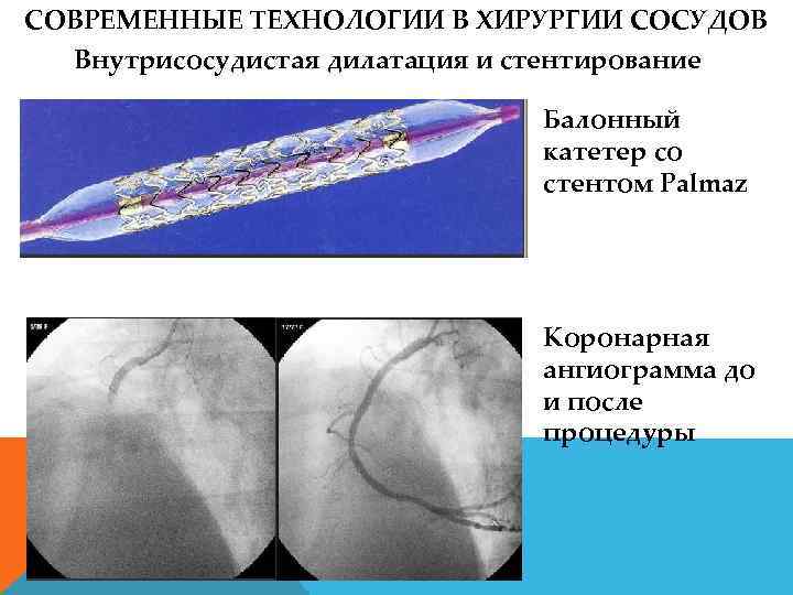 СОВРЕМЕННЫЕ ТЕХНОЛОГИИ В ХИРУРГИИ СОСУДОВ Внутрисосудистая дилатация и стентирование Балонный катетер со стентом Palmaz