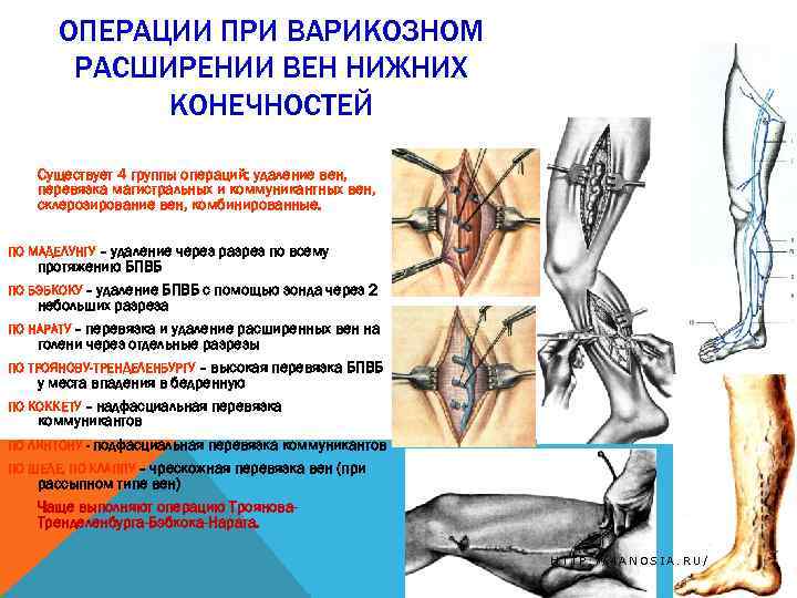 ОПЕРАЦИИ ПРИ ВАРИКОЗНОМ РАСШИРЕНИИ ВЕН НИЖНИХ КОНЕЧНОСТЕЙ Существует 4 группы операций: удаление вен, перевязка