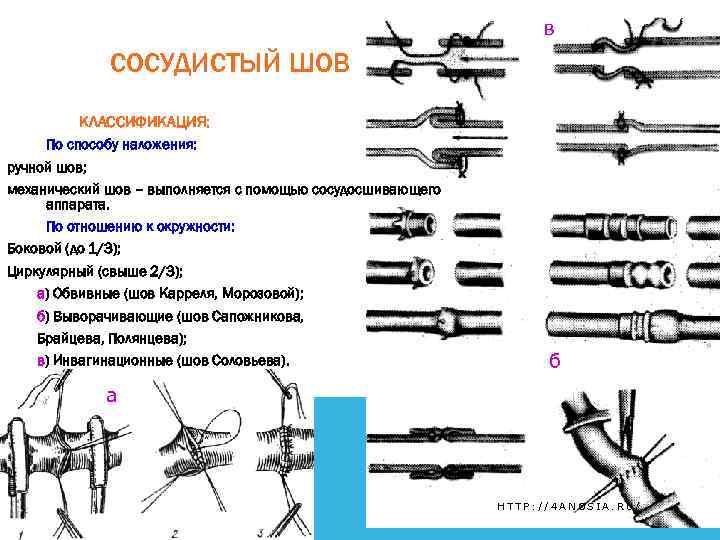 в СОСУДИСТЫЙ ШОВ КЛАССИФИКАЦИЯ: По способу наложения: ручной шов; механический шов – выполняется с