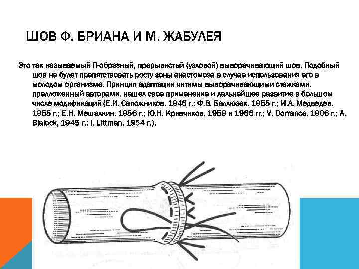 ШОВ Ф. БРИАНА И М. ЖАБУЛЕЯ Это так называемый П-образный, прерывистый (узловой) выворачивающий шов.