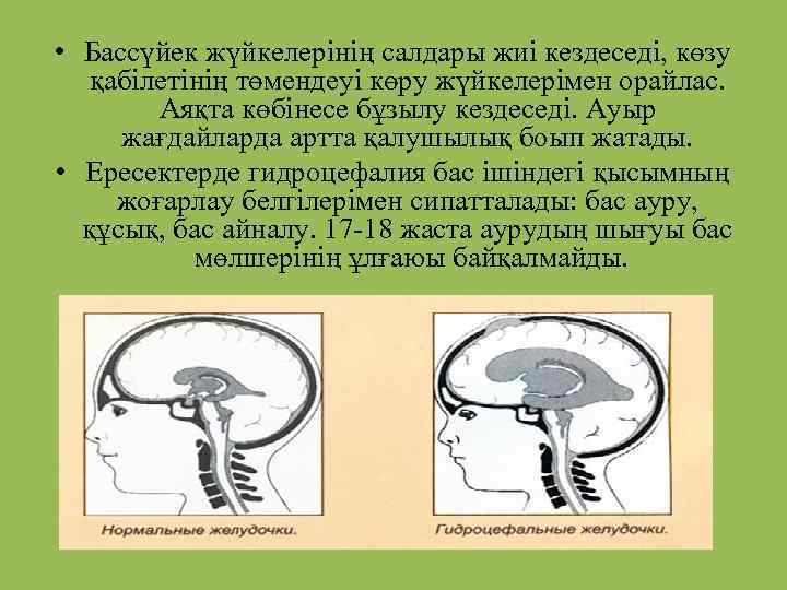  • Бассүйек жүйкелерінің салдары жиі кездеседі, көзу қабілетінің төмендеуі көру жүйкелерімен орайлас. Аяқта