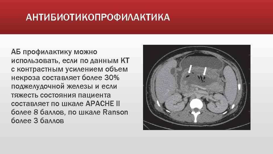 АНТИБИОТИКОПРОФИЛАКТИКА АБ профилактику можно использовать, если по данным КТ с контрастным усилением объем некроза