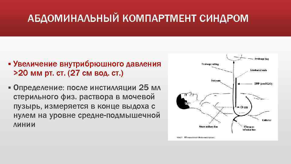 АБДОМИНАЛЬНЫЙ КОМПАРТМЕНТ СИНДРОМ § Увеличение внутрибрюшного давления >20 мм рт. ст. (27 см вод.