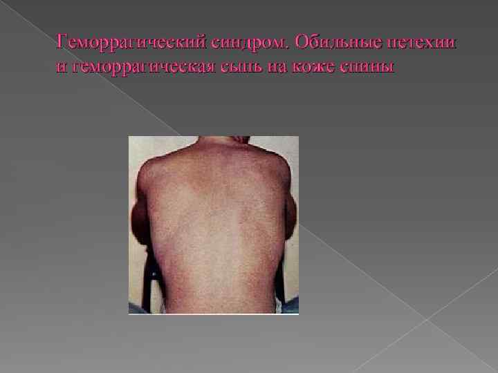 Геморрагический синдром. Обильные петехии и геморрагическая сыпь на коже спины 