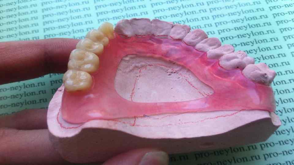 Нейлоновый протез зубов фото