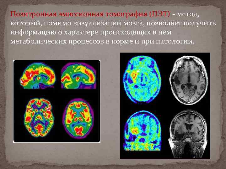 Позитронная эмиссионная томография (ПЭТ) - метод, который, помимо визуализации мозга, позволяет получить информацию о