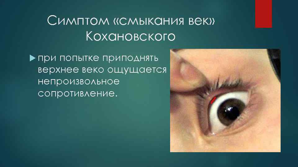 Симптом «смыкания век» Кохановского при попытке приподнять верхнее веко ощущается непроизвольное сопротивление. 