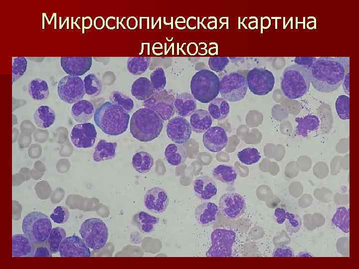 Мозг при остром лейкозе. Микроскопия хронический миелобластный лейкоз. Острый лейкоз мазок крови. Острый лейкоз картина крови. Мазок крови острый миелолейкоз.