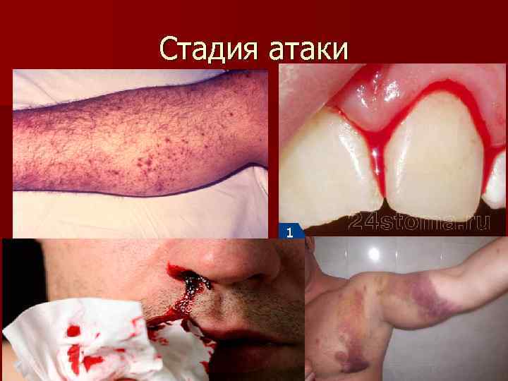 Стадия атаки 