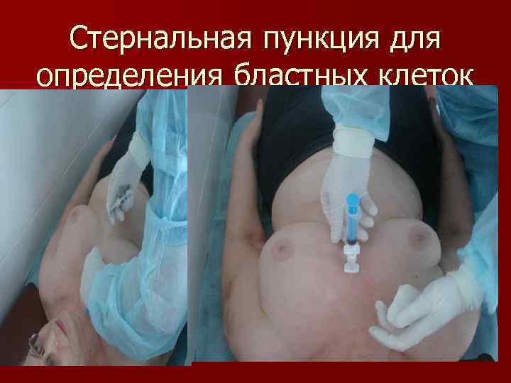 Стернальная пункция для определения бластных клеток 