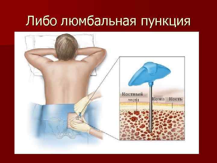 Либо люмбальная пункция 