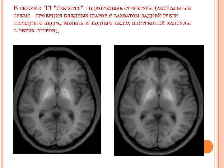 В РЕЖИМЕ Т 1 "СВЕТЯТСЯ" ПОДКОРКОВЫЕ СТРУКТУРЫ (АКСИАЛЬНЫЕ СРЕЗЫ - ПРОЕКЦИЯ БЛЕДНЫХ ШАРОВ С