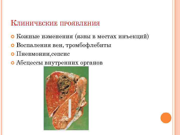 КЛИНИЧЕСКИЕ ПРОЯВЛЕНИЯ Кожные изменения (язвы в местах инъекций) Воспаления вен, тромбофлебиты Пневмонии, сепсис Абсцессы