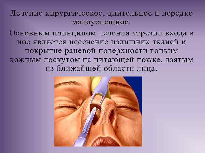 Лечение хирургическое, длительное и нередко малоуспешное. Основным принципом лечения атрезии входа в нос является