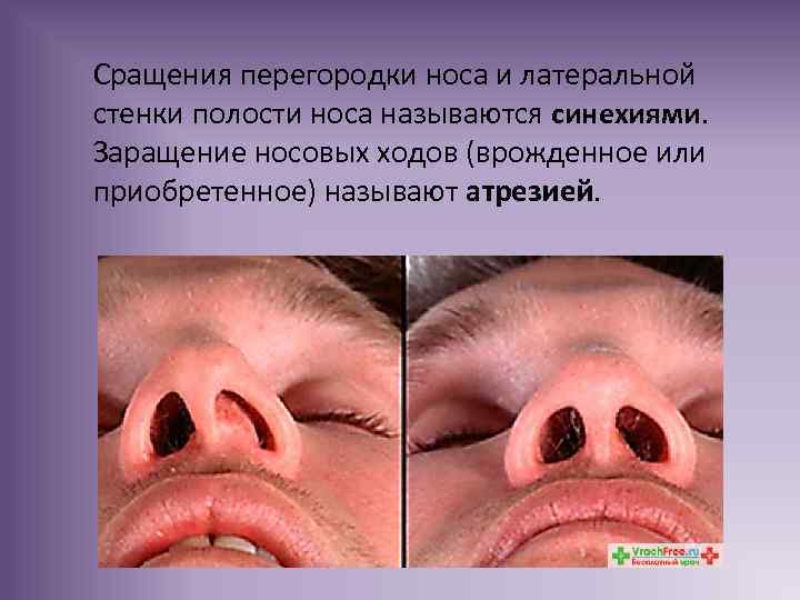 Сращения перегородки носа и латеральной стенки полости носа называются синехиями. Заращение носовых ходов (врожденное
