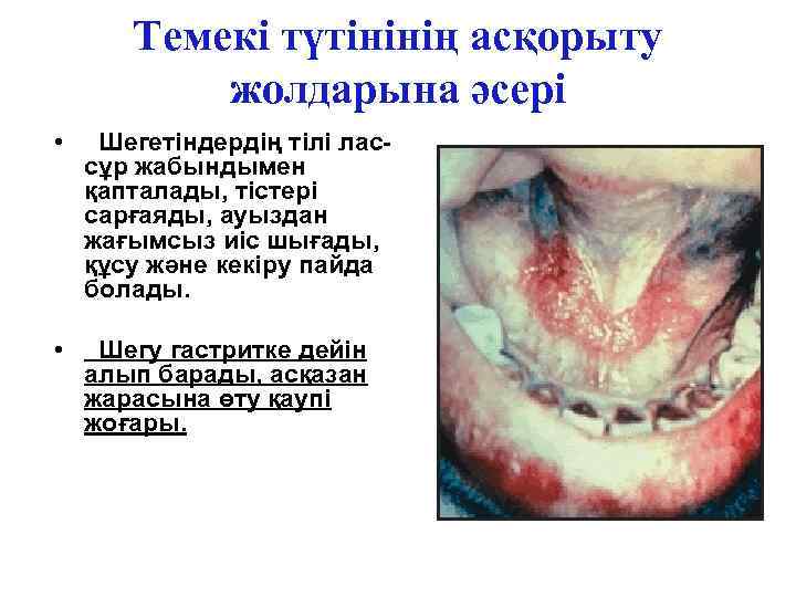 Темекі түтінінің асқорыту жолдарына әсері • Шегетіндердің тілі лассұр жабындымен қапталады, тістері сарғаяды, ауыздан