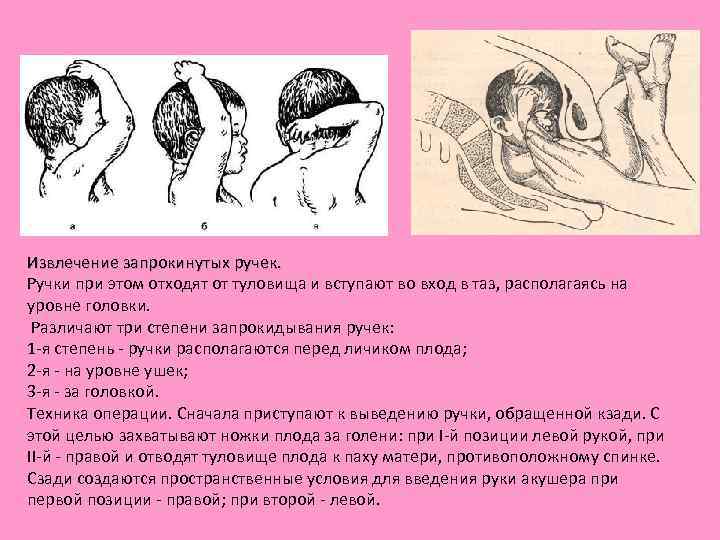 Извлечение запрокинутых ручек. Ручки при этом отходят от туловища и вступают во вход в