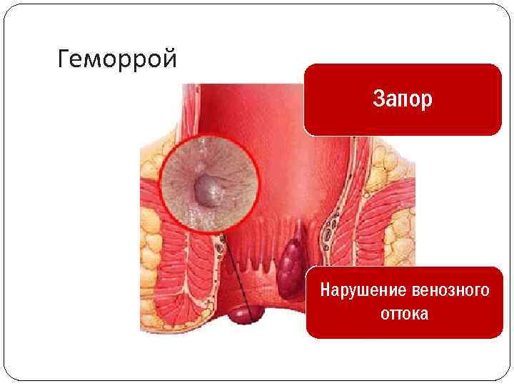 Геморрой Запор Нарушение венозного оттока 