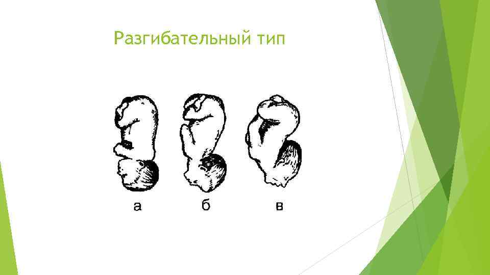 Разгибательный тип 