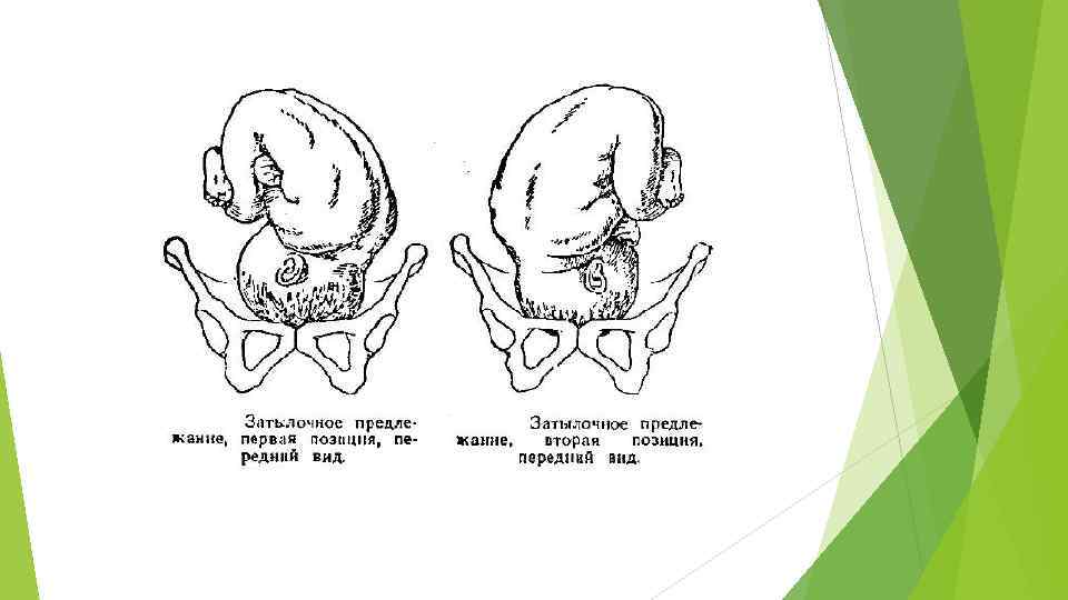 Рисунок 1 1 позиция. Передний вид затылочного предлежания 2 позиция. Головное предлежание плода 1 позиция передний вид. Положение продольное предлежание головное 1 позиция передний вид. 1 Позиция передний вид затылочного предлежания.