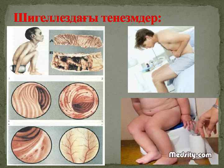 Шигеллездағы тенезмдер: 