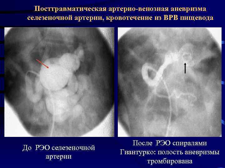 Аневризма селезеночной артерии