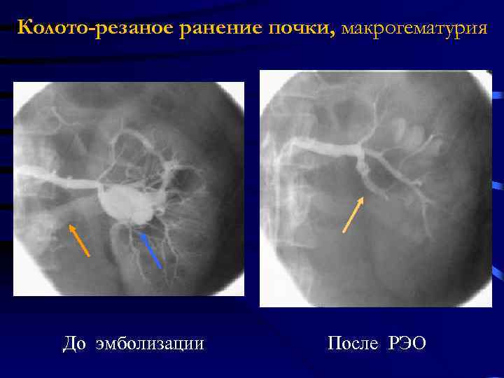 Колото резаных ран