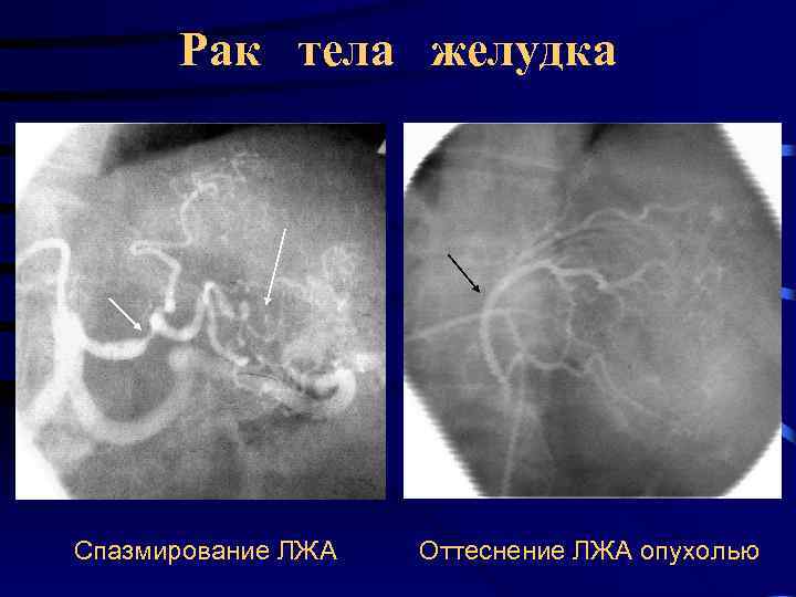 Рак тела желудка Спазмирование ЛЖА Оттеснение ЛЖА опухолью 