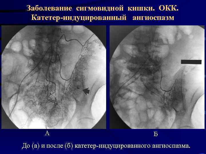 Заболевание сигмовидной кишки. ОКК. Катетер-индуцированный ангиоспазм А Б До (а) и после (б) катетер-индуцированного