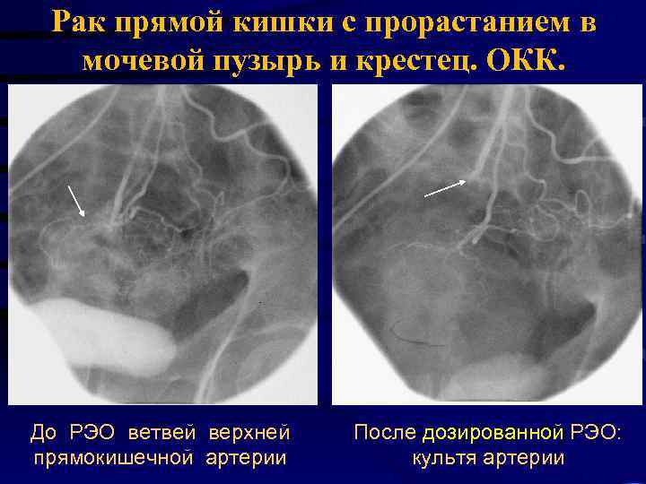 Рак прямой кишки с прорастанием в мочевой пузырь и крестец. ОКК. До РЭО ветвей