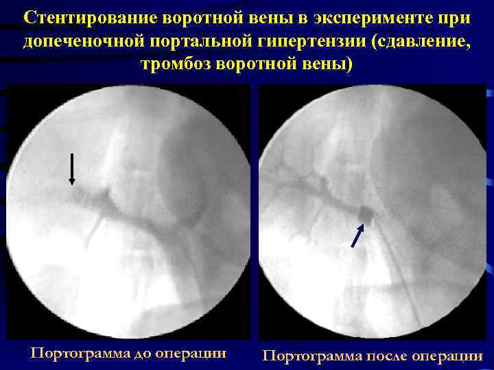 Стентирование воротной вены в эксперименте при допеченочной портальной гипертензии (сдавление, тромбоз воротной вены) Портограмма