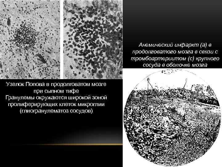 Анемический инфаркт (а) в продолговатого мозга в связи с тромбоартериитом (с) крупного сосуда в