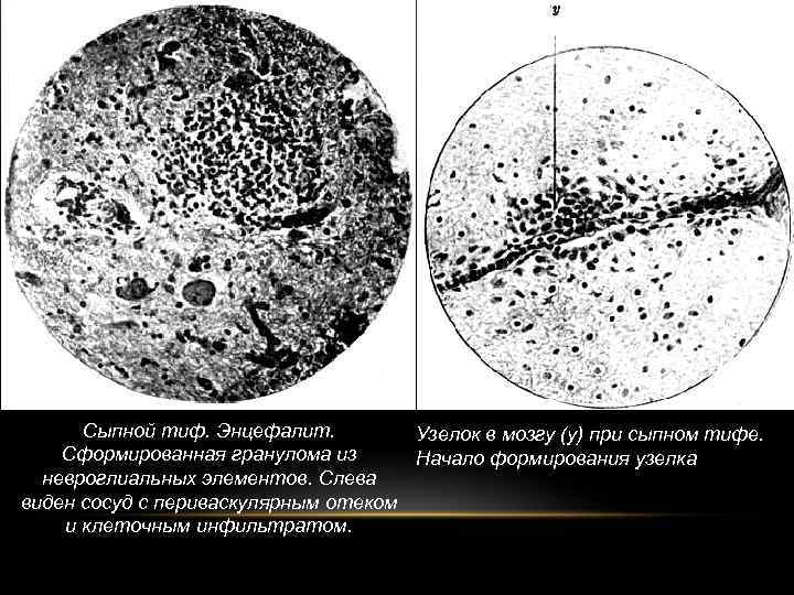 Сыпной тиф клиническая картина