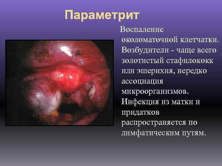 Параметрит Воспаление околоматочной клетчатки. Возбудители - чаще всего золотистый стафилококк или эшерихия, нередко ассоциация