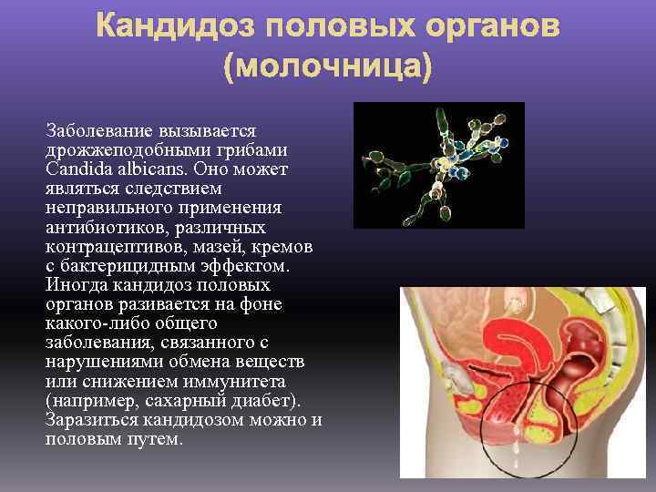 Кандидоз половых органов (молочница) Заболевание вызывается дрожжеподобными грибами Candida albicans. Оно может являться следствием