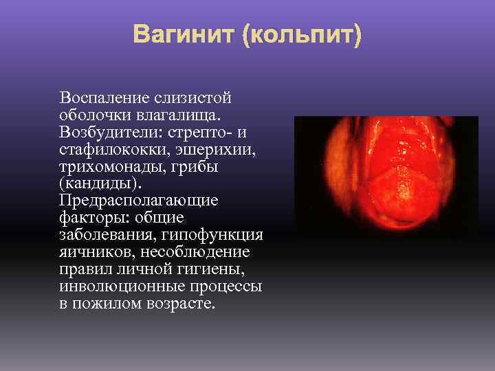 Вагинит (кольпит) Воспаление слизистой оболочки влагалища. Возбудители: стрепто- и стафилококки, эшерихии, трихомонады, грибы (кандиды).
