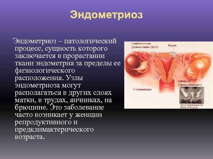 Эндометриоз – патологический процесс, сущность которого заключается в прорастании ткани эндометрия за пределы ее