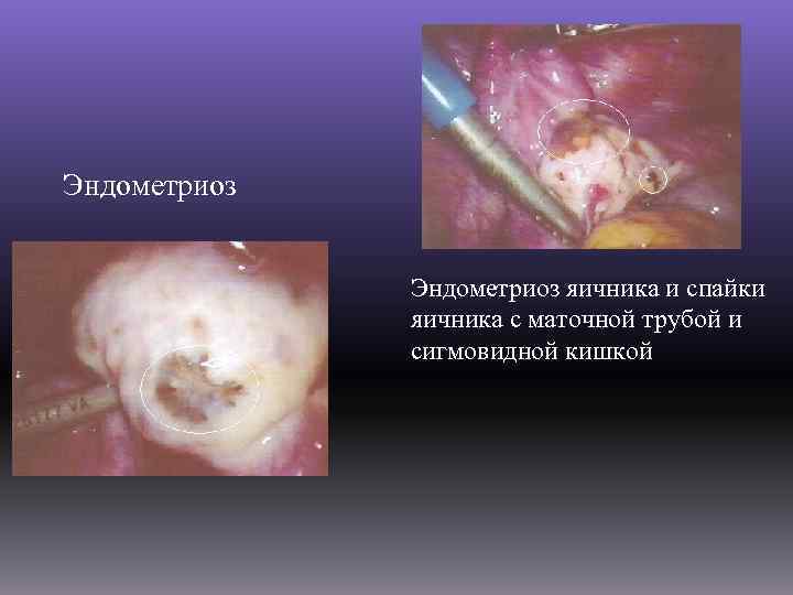 Эндометриоз яичника и спайки яичника с маточной трубой и сигмовидной кишкой 