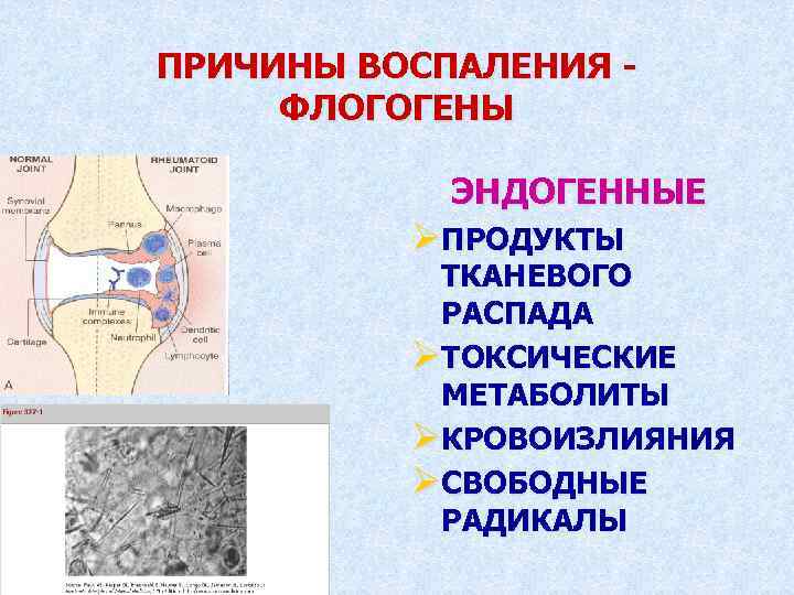 ПРИЧИНЫ ВОСПАЛЕНИЯ ФЛОГОГЕНЫ ЭНДОГЕННЫЕ ØПРОДУКТЫ ТКАНЕВОГО РАСПАДА ØТОКСИЧЕСКИЕ МЕТАБОЛИТЫ ØКРОВОИЗЛИЯНИЯ ØСВОБОДНЫЕ РАДИКАЛЫ 