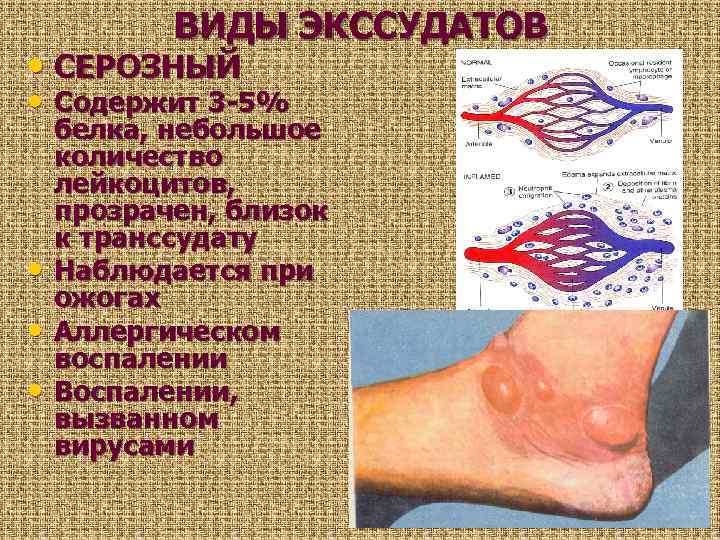 ВИДЫ ЭКССУДАТОВ • СЕРОЗНЫЙ • Содержит 3 -5% • • • белка, небольшое количество